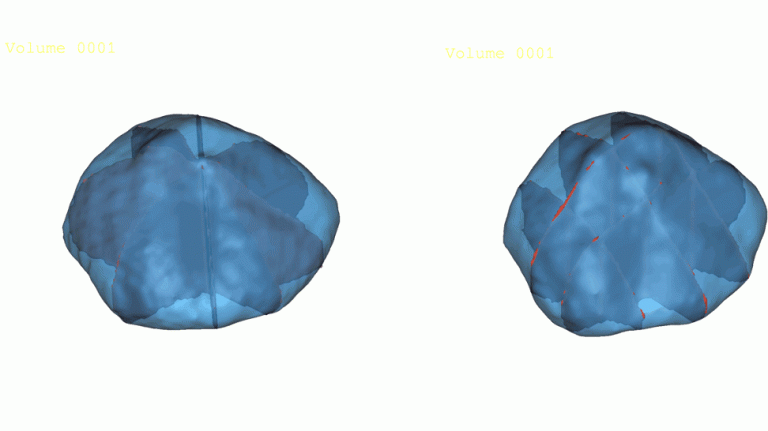 DynPelvis3D (Suivi dynamique et Caractérisation des déformations pelviennes pathologiques par IRM 3D Utra-Rapide)