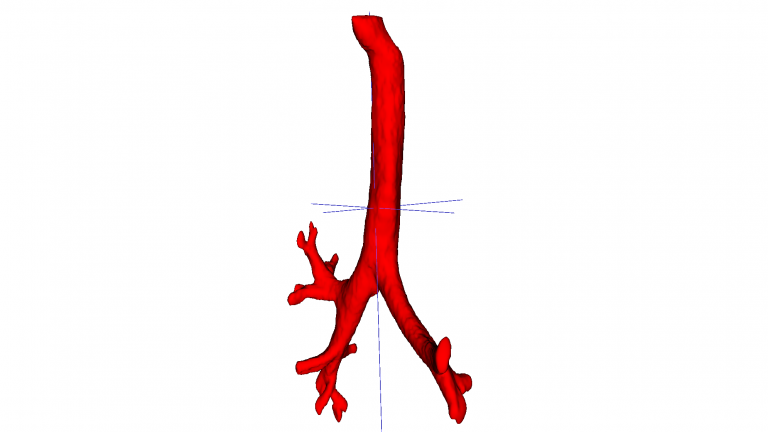 PedIATrach : Pediatric trachea, from artificial intelligence-assisted airflow modeling to clinical management